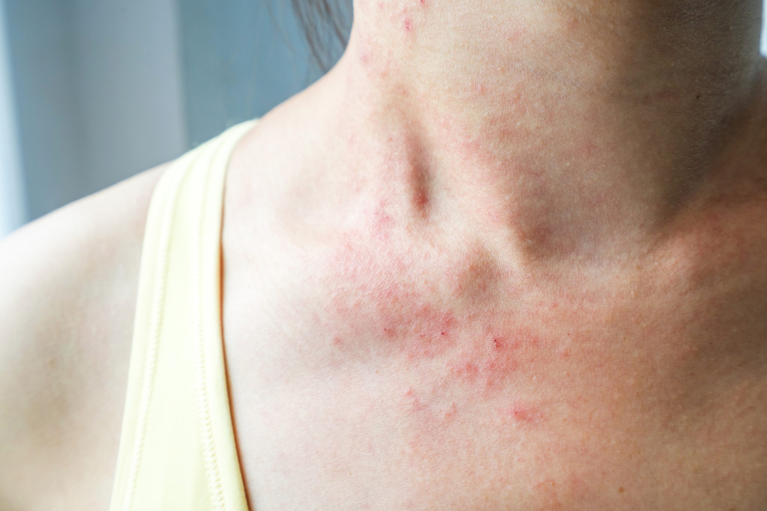 young woman has skin rash itch neck scaled -